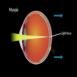 Myopia Research: From Genetics to Interventions :: Ophthalmology and Vision Science