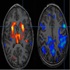 Neuroimaging and neurophysiology :: Neurology and Neurological Disorders