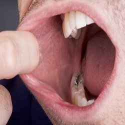 Oral Cancer :: Advanced Dental and Oral Health