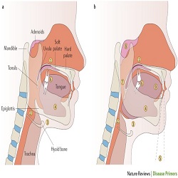 Sleep Apnea Syndrome :: Advanced Dental and Oral Health