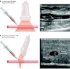 AI-Guided Vascular Access Planning :: Nephrology & Urology