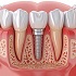 Implant Surgery & Osseointegration Techniques :: Advanced Dental and Oral Health
