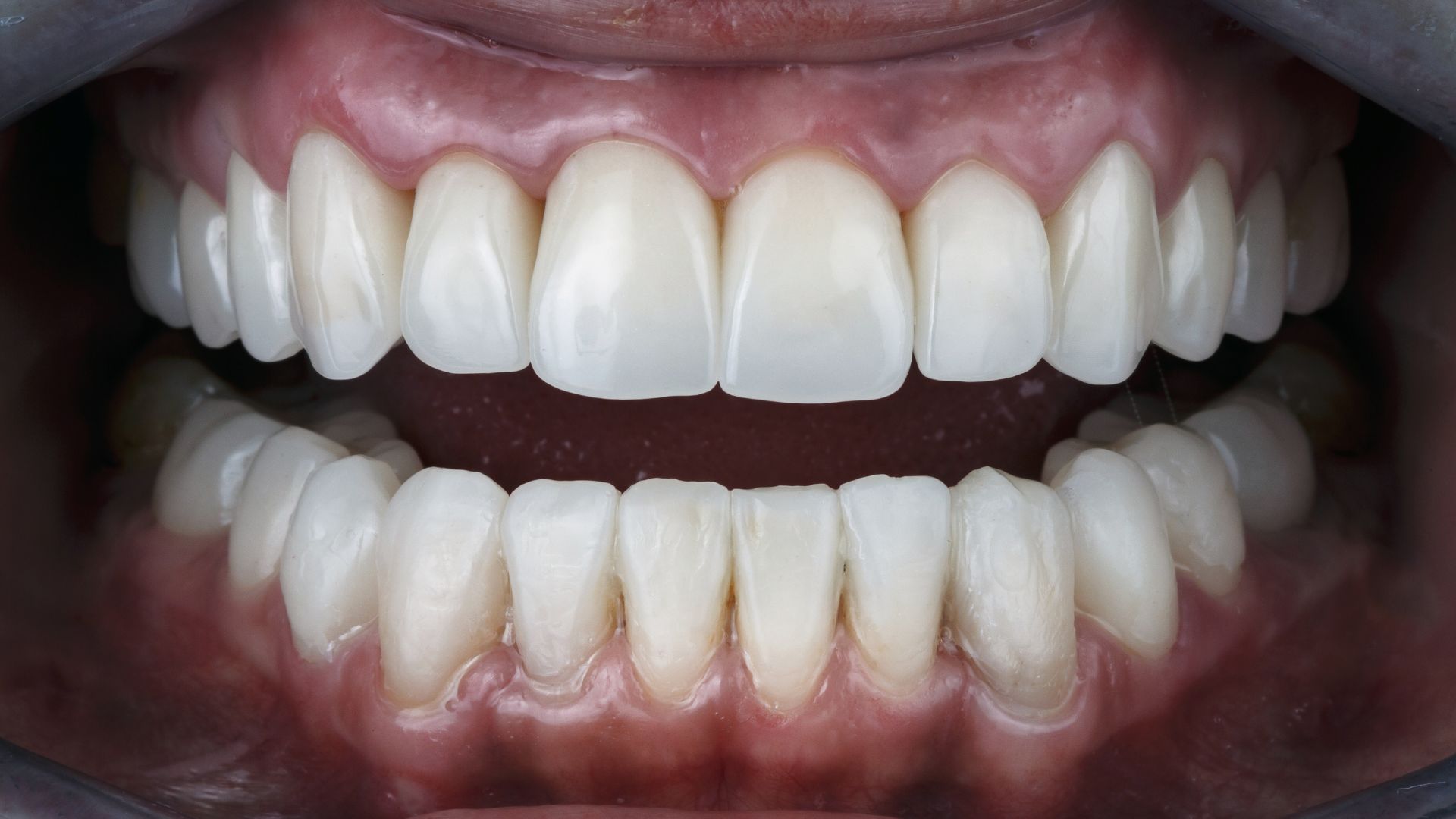 Full-Mouth Rehabilitation & Complex Prosthodontics :: Advanced Dental and Oral Health