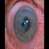 Cornea Disorders and Treatments :: Ophthalmology and Vision Science