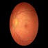 Diabetic Retinopathy :: Ophthalmology and Vision Science