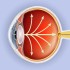 Glaucoma: A Vision Loss :: Ophthalmology and Vision Science
