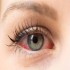Dry Eye and Keratoconus :: Ophthalmology and Vision Science