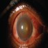 Uveitis :: Ophthalmology and Vision Science