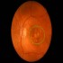Macular Degeneration :: Ophthalmology and Vision Science