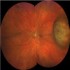 Ocular Oncology :: Ophthalmology and Vision Science